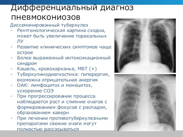 Дифференциальный диагноз пневмокониозов Диссеминированный туберкулез Рентгенологическая картина сходна, может быть увеличение
