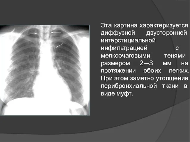 Эта картина характеризуется диффузной двусторонней интерстициальной инфильтрацией с мелкоочаговыми тенями размером