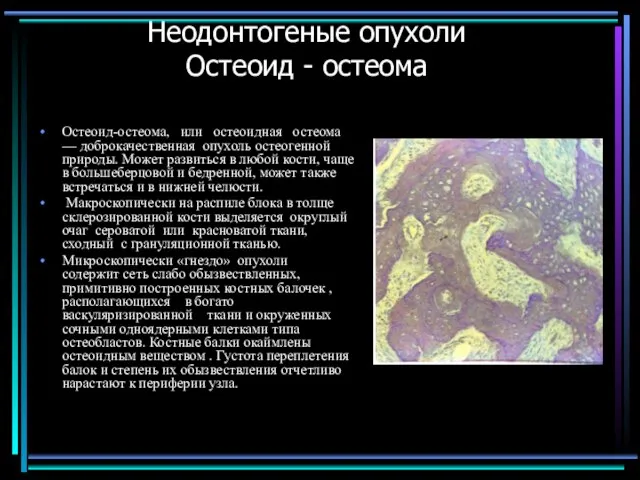 Неодонтогеные опухоли Остеоид - остеома Остеоид-остеома, или остеоидная остеома — доброкачественная