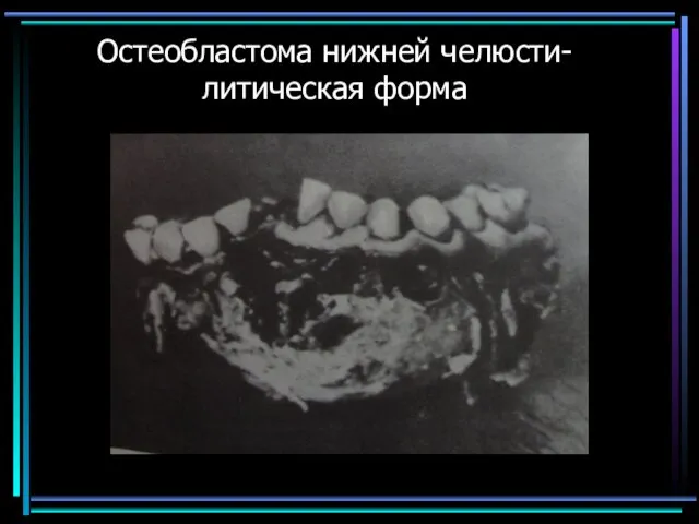 Остеобластома нижней челюсти-литическая форма