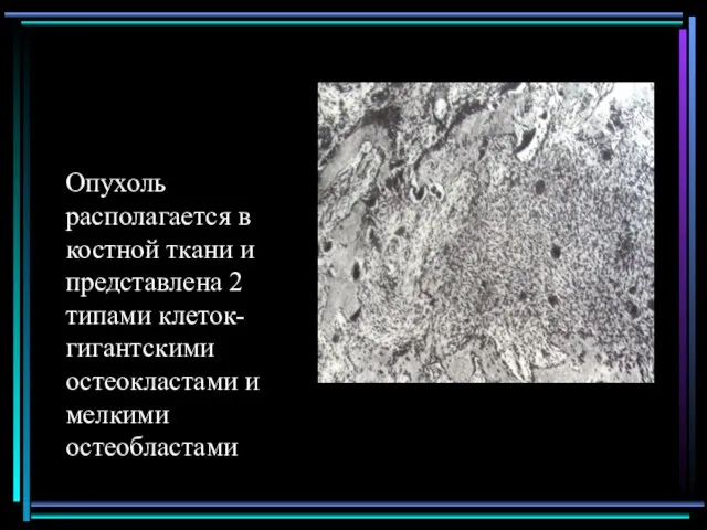 Опухоль располагается в костной ткани и представлена 2 типами клеток-гигантскими остеокластами и мелкими остеобластами