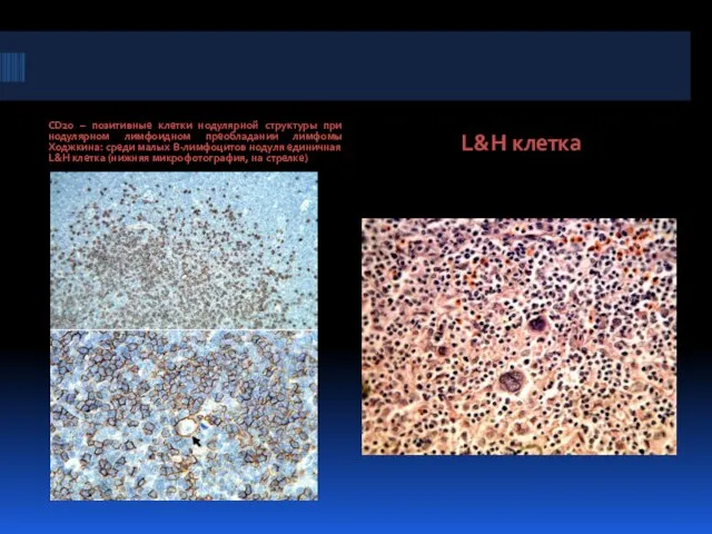 CD20 – позитивные клетки нодулярной структуры при нодулярном лимфоидном преобладании лимфомы