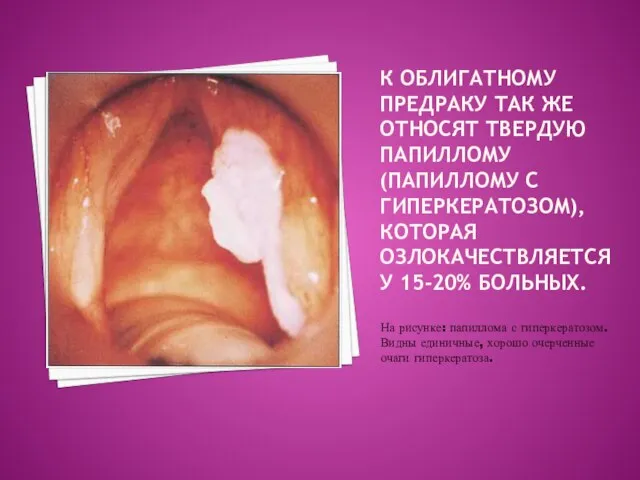 К облигатному предраку так же относят твердую папиллому (папиллому с гиперкератозом),