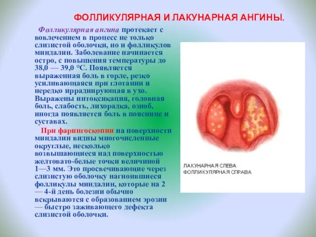 ФОЛЛИКУЛЯРНАЯ И ЛАКУНАРНАЯ АНГИНЫ. Фолликулярная ангина протекает с вовлечением в процесс