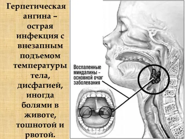 Герпетическая ангина – острая инфекция с внезапным подъемом температуры тела, дисфагией,