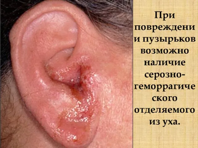 При повреждении пузырьков возможно наличие серозно-геморрагического отделяемого из уха.