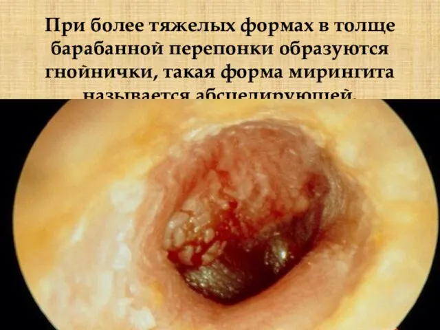 При более тяжелых формах в толще барабанной перепонки образуются гнойнички, такая форма мирингита называется абсцедирующей.