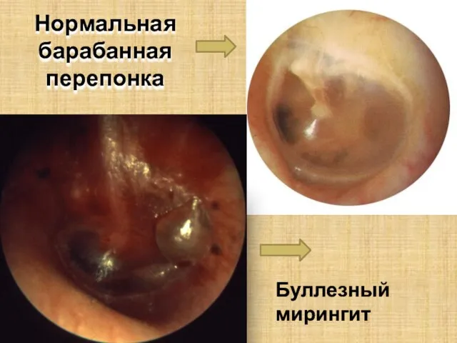 Нормальная барабанная перепонка Буллезный мирингит