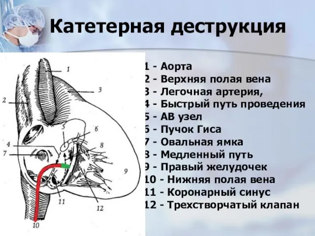 Катетерная деструкция 1 - Аорта 2 - Верхняя полая вена 3