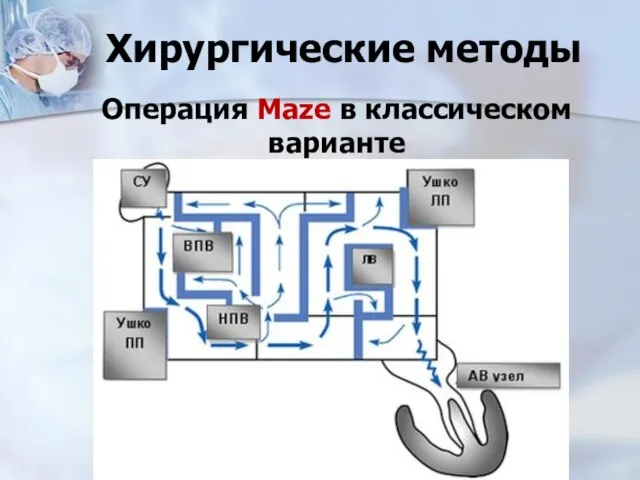 Хирургические методы Операция Maze в классическом варианте