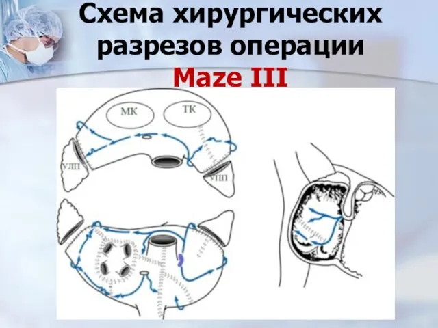 Схема хирургических разрезов операции Maze III