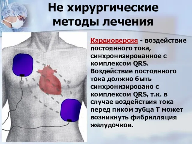 Не хирургические методы лечения Кардиоверсия - воздействие постоянного тока, синхронизированное с