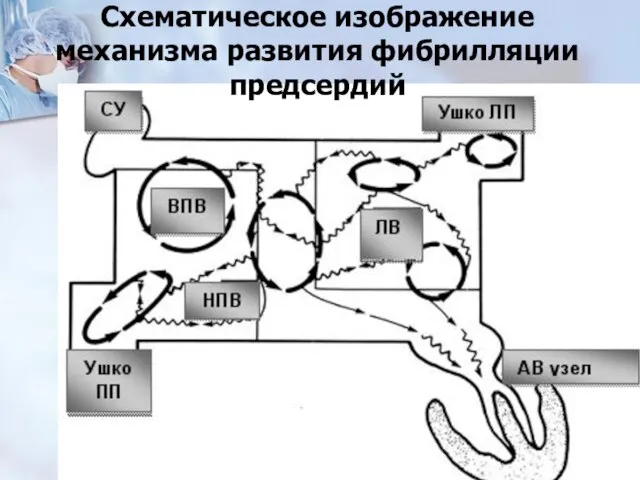 Схематическое изображение механизма развития фибрилляции предсердий