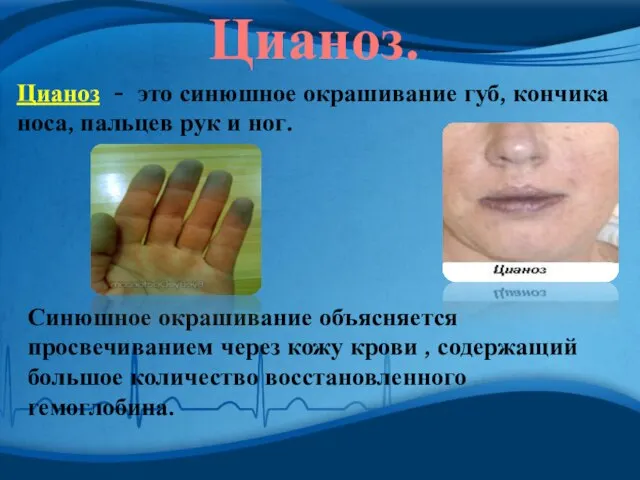 Цианоз. Цианоз - это синюшное окрашивание губ, кончика носа, пальцев рук