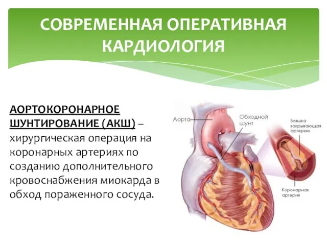 СОВРЕМЕННАЯ ОПЕРАТИВНАЯ КАРДИОЛОГИЯ АОРТОКОРОНАРНОЕ ШУНТИРОВАНИЕ (АКШ) – хирургическая операция на коронарных