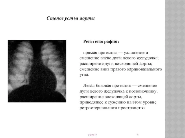 Стеноз устья аорты Рентгенография: прямая проекция — удлинение и смешение влево