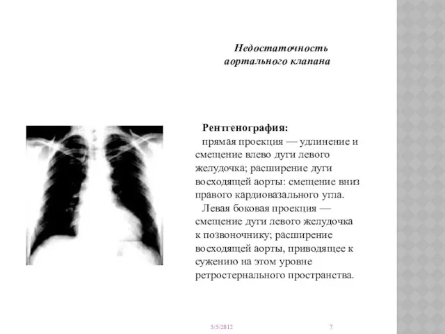 Недостаточность аортального клапана Рентгенография: прямая проекция — удлинение и смещение влево
