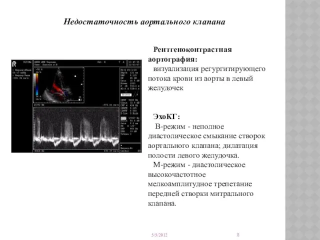 Рентгеноконтрастная аортография: визуализация регургитирующего потока крови из аорты в левый желудочек