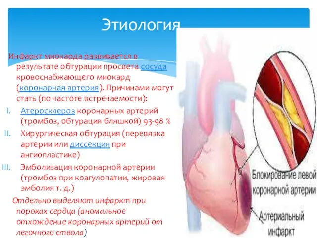 Этиология Инфаркт миокарда развивается в результате обтурации просвета сосуда кровоснабжающего миокард