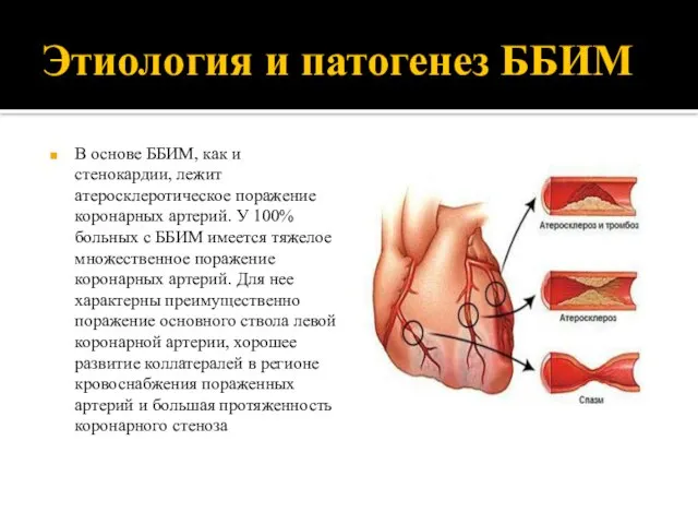 Этиология и патогенез ББИМ В основе ББИМ, как и стенокардии, лежит