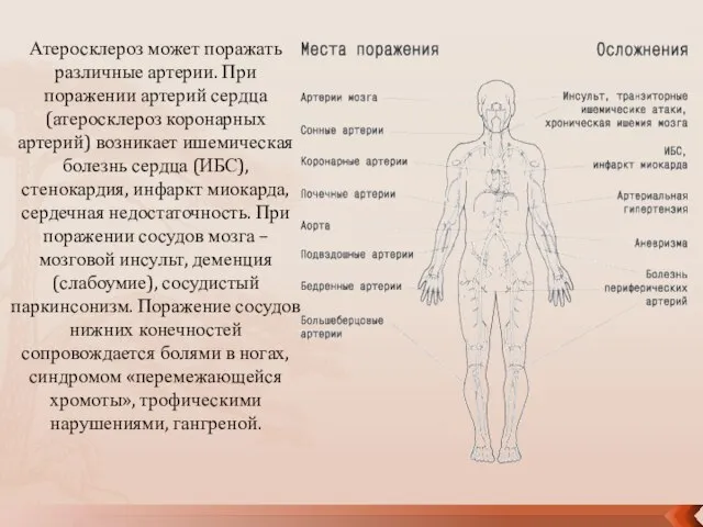 Атеросклероз может поражать различные артерии. При поражении артерий сердца (атеросклероз коронарных