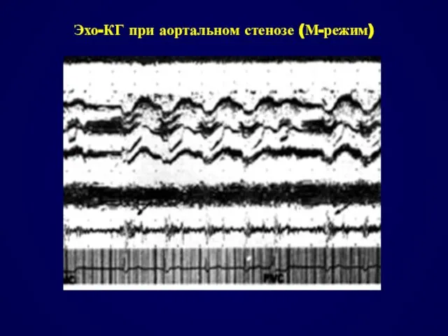 Эхо-КГ при аортальном стенозе (М-режим)