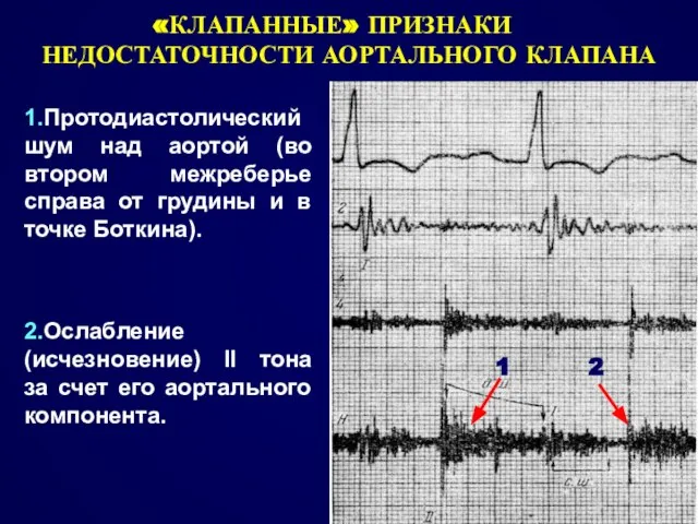 «КЛАПАННЫЕ» ПРИЗНАКИ НЕДОСТАТОЧНОСТИ АОРТАЛЬНОГО КЛАПАНА 1 2