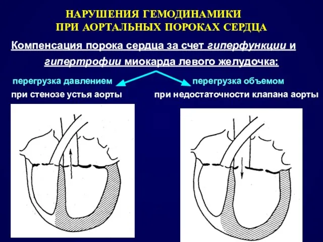 НАРУШЕНИЯ ГЕМОДИНАМИКИ ПРИ АОРТАЛЬНЫХ ПОРОКАХ СЕРДЦА Компенсация порока сердца за счет