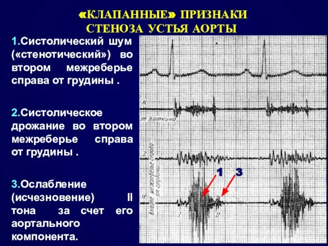 «КЛАПАННЫЕ» ПРИЗНАКИ СТЕНОЗА УСТЬЯ АОРТЫ 1 3