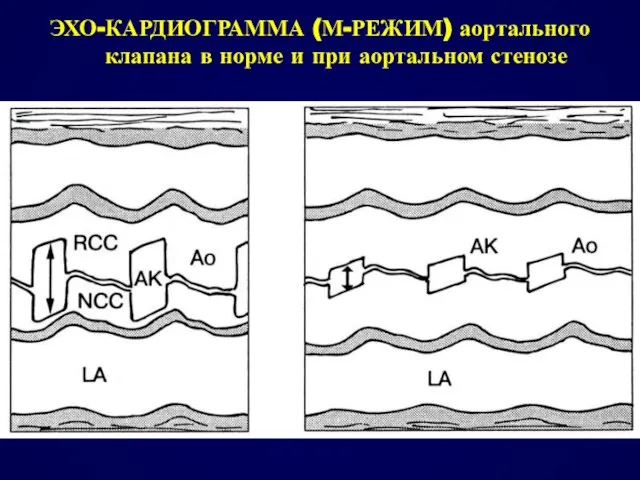 ЭХО-КАРДИОГРАММА (М-РЕЖИМ) аортального клапана в норме и при аортальном стенозе