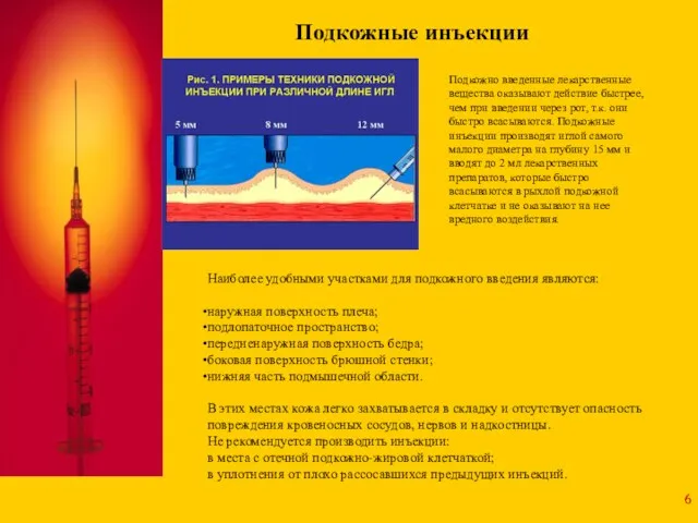 Наиболее удобными участками для подкожного введения являются: наружная поверхность плеча; подлопаточное