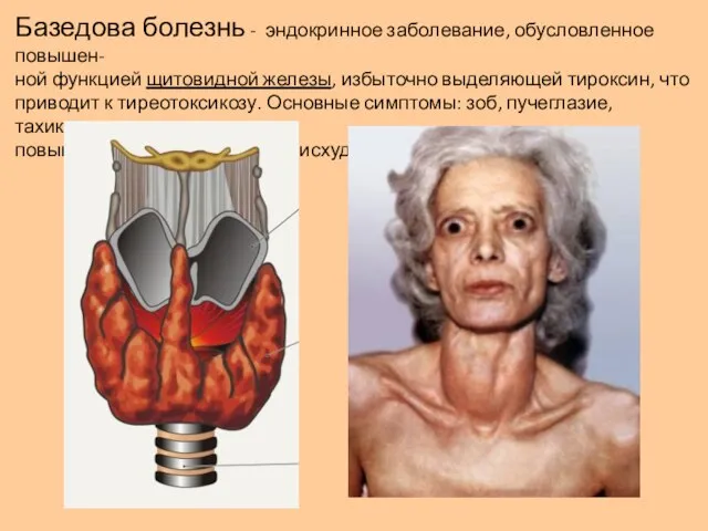 Базедова болезнь - эндокринное заболевание, обусловленное повышен- ной функцией щитовидной железы,