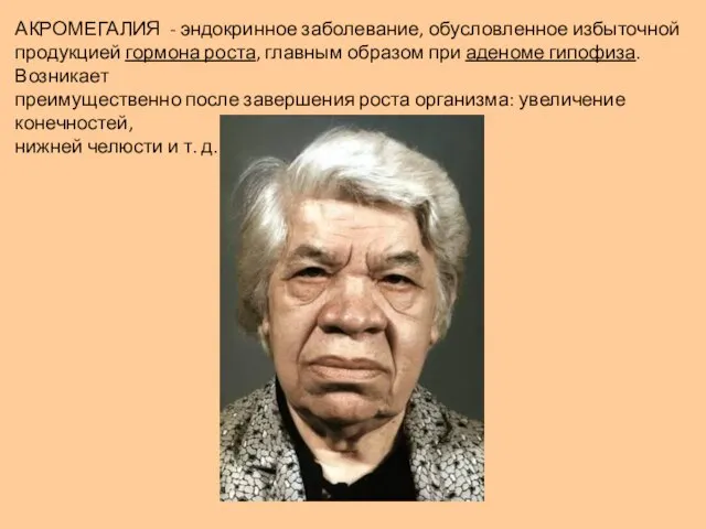 АКРОМЕГАЛИЯ - эндокринное заболевание, обусловленное избыточной продукцией гормона роста, главным образом