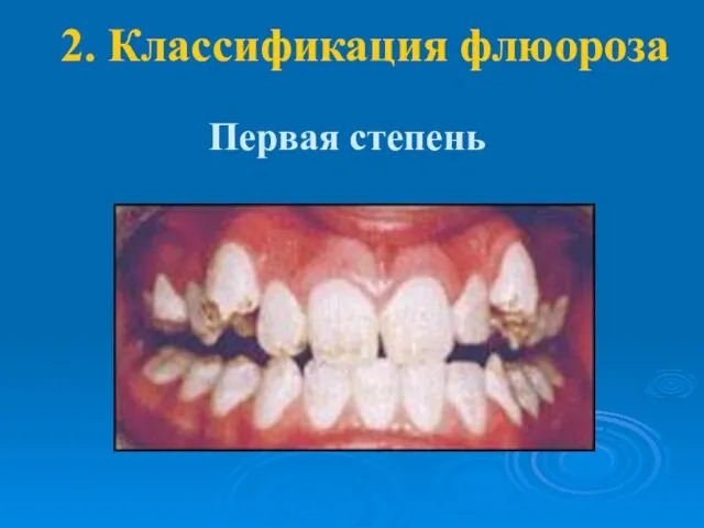 2. Классификация флюороза Первая степень