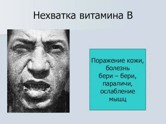 Нехватка витамина В Поражение кожи, болезнь бери – бери, параличи, ослабление мышц