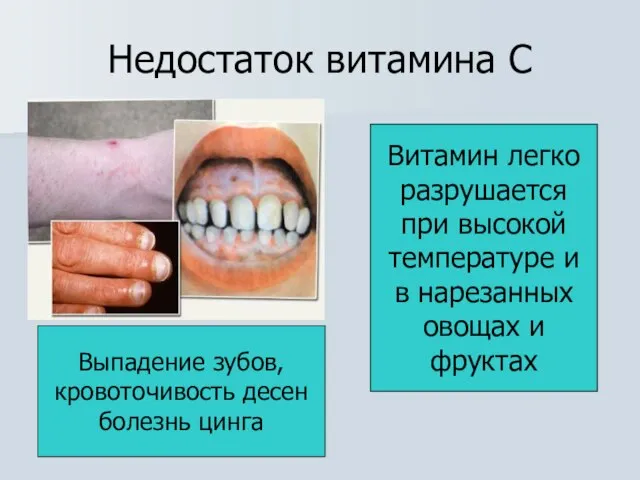 Недостаток витамина С Выпадение зубов, кровоточивость десен болезнь цинга Витамин легко