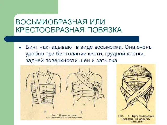 ВОСЬМИОБРАЗНАЯ ИЛИ КРЕСТООБРАЗНАЯ ПОВЯЗКА Бинт накладывают в виде восьмерки. Она очень
