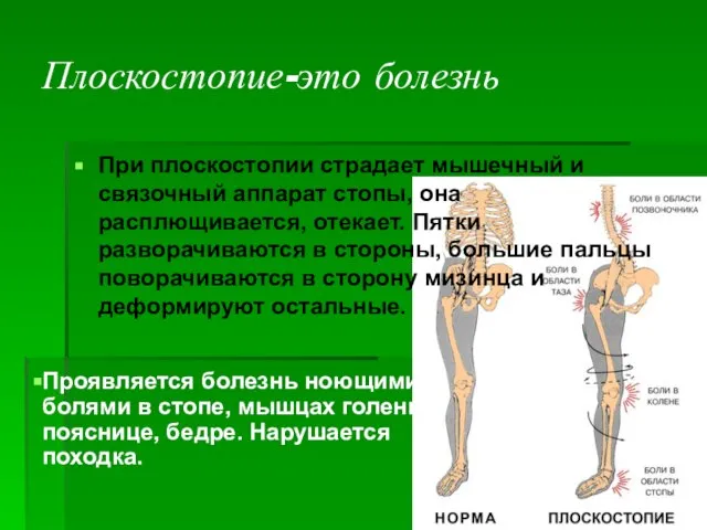 Плоскостопие-это болезнь При плоскостопии страдает мышечный и связочный аппарат стопы, она