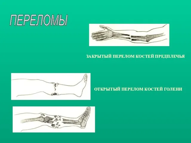 ЗАКРЫТЫЙ ПЕРЕЛОМ КОСТЕЙ ПРЕДПЛЕЧЬЯ ОТКРЫТЫЙ ПЕРЕЛОМ КОСТЕЙ ГОЛЕНИ ПЕРЕЛОМЫ