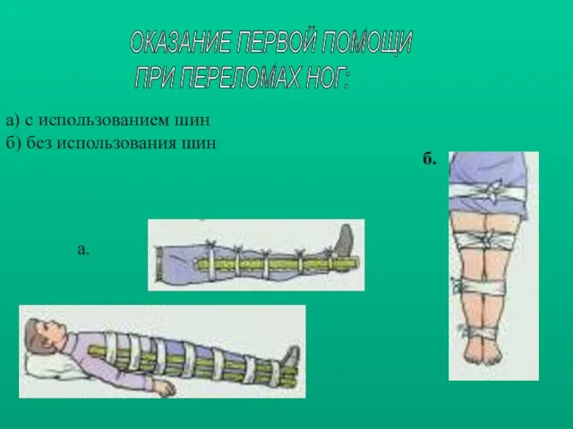 а) с использованием шин б) без использования шин а. б. ОКАЗАНИЕ ПЕРВОЙ ПОМОЩИ ПРИ ПЕРЕЛОМАХ НОГ: