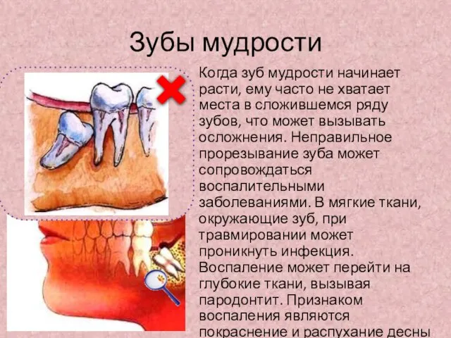 Зубы мудрости Когда зуб мудрости начинает расти, ему часто не хватает