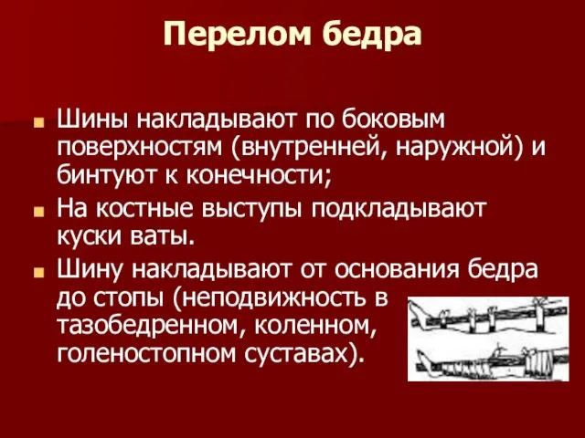 Перелом бедра Шины накладывают по боковым поверхностям (внутренней, наружной) и бинтуют