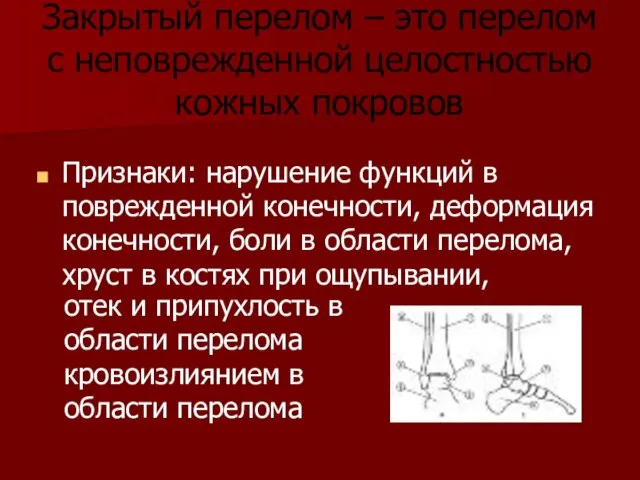 Закрытый перелом – это перелом с неповрежденной целостностью кожных покровов Признаки: