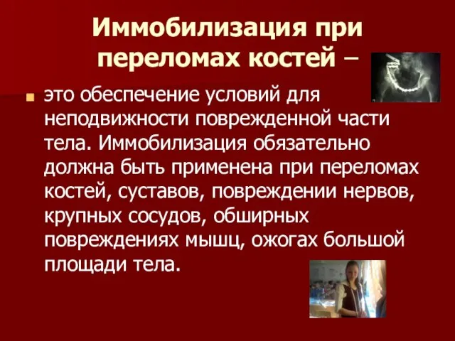 Иммобилизация при переломах костей – это обеспечение условий для неподвижности поврежденной