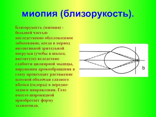 миопия (близорукость). Близорукость (миопия) - большей частью наследственно обусловленное заболевание, когда