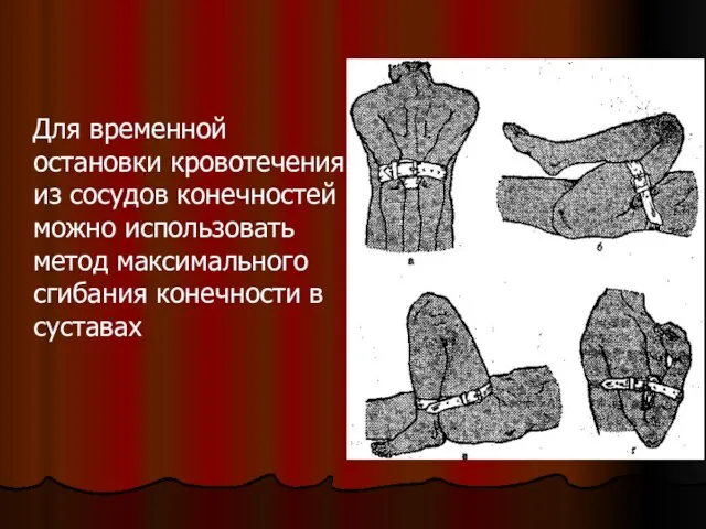 Для временной остановки кровотечения из сосудов конечностей можно использовать метод максимального сгибания конечности в суставах