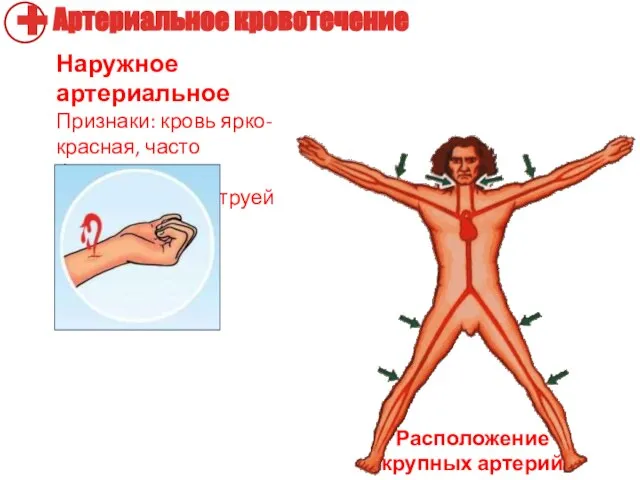 Наружное артериальное Признаки: кровь ярко-красная, часто фонтанирует пульсирующей струей Расположение крупных артерий