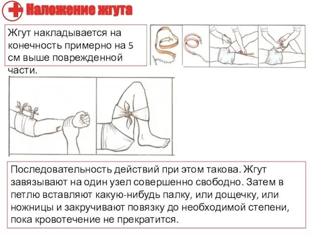 Жгут накладывается на конечность примерно на 5 см выше поврежденной части.