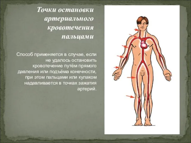 Точки остановки артериального кровотечения пальцами Способ применяется в случае, если не