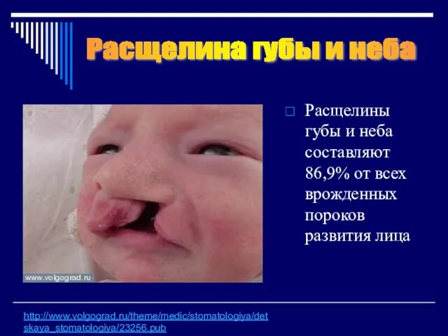 Расщелины губы и неба составляют 86,9% от всех врожденных пороков развития